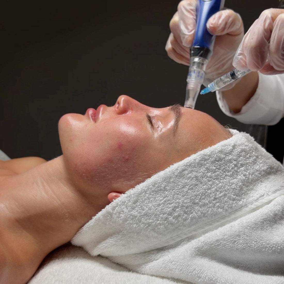 What Is Microneedling? Complete Guide to Microneedling Treatment, Acne Scars, Exosomes & Aftercare